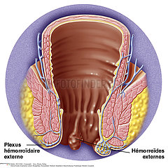 HEMORROIDE DESSIN!!HEMORRHOID  ILLUSTRATION