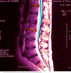 COLONNE VERTEBRALE RMN!!SPINAL COLUMN  MRI