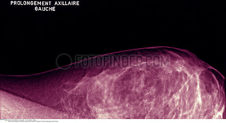 SEIN RADIOGRAPHIE!!BREAST  X-RAY