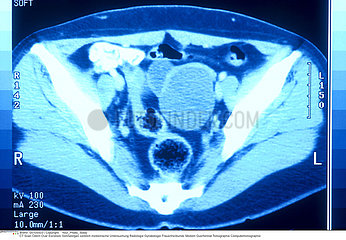 OEDEME OVAIRE SCANNER!!EDEMA OF THE OVARY  SCAN