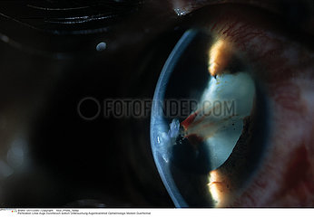 PERFORATION CRISTALLIN!!PERFORATION OF THE LENS