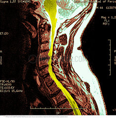 COLONNE VERTEBRALE RMN!!SPINAL COLUMN  MRI