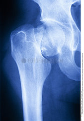 FRACTURE HANCHE RADIO!!FRACTURED HIP  X-RAY