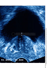 CANCER PROSTATE ECHOGRAPHIE!!CANCER OF THE PROSTATE SONOGRAPH