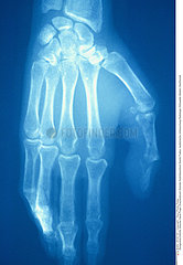 FRACTURE MAIN RADIO!!FRACTURED HAND  X-RAY