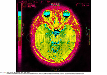 CERVEAU RMN!!BRAIN  MRI