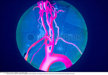THROMBOSE ARTERE ANGIOGRAPHIE!!ARTERIAL THROMBOSIS  ANGIOGRAPHY