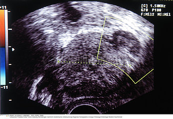 CANCER PROSTATE ECHOGRAPHIE!!CANCER OF THE PROSTATE SONOGRAPH