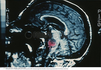ANEVRYSME CERVEAU RMN!!ANEURYSM OF THE BRAIN  MRI