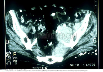 CANCER OVAIRE SCANNER!!CANCER OF THE OVARIES  SCAN