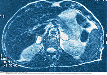 SURRENALE RMN!!ADRENAL GLAND  MRI