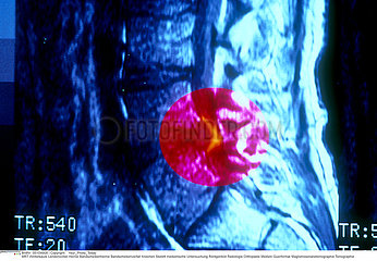 HERNIE DISCALE RMN!!HERNIATED DISK  MRI
