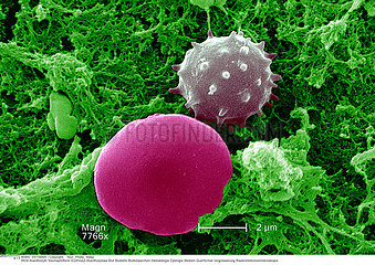 HEMATIE ACANTHOCYTE!!ACANTHOCYTE  RED BLOOD CELL