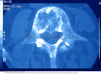 OSTEOPOROSE RMN!!OSTEOPOROSIS  MRI