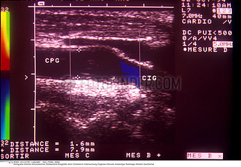 ATHEROME ECHOGRAPHIE!!ATHEROMA  SONOGRAPHY