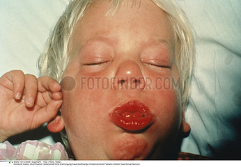COQUELUCHE!!WHOOPING COUGH