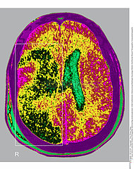 ACCIDENT VASCULAIRE CERVEAU SCAN!!CEREBROVASCULAR ACCIDENT  SCAN