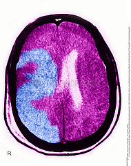 ACCIDENT VASCULAIRE CERVEAU SCAN!!CEREBROVASCULAR ACCIDENT  SCAN