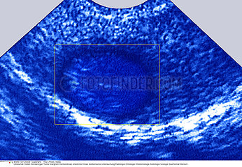 CANCER TESTICULE ECHOGRAPHIE!!CANCER OF THE TESTICLE  SONOGRAP