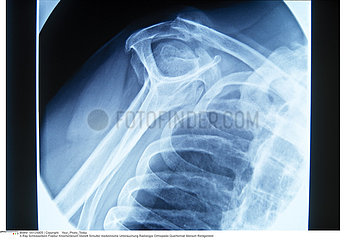 FRACTURE CLAVICULE RADIO!!FRACTURED COLLARBONE  X-RAY