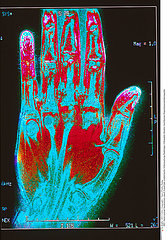 MAIN RMN!!HAND  MRI