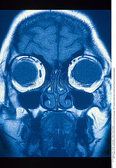 SINUS RMN!!SINUS  MRI