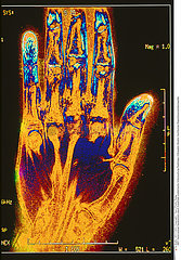 MAIN RMN!!HAND  MRI