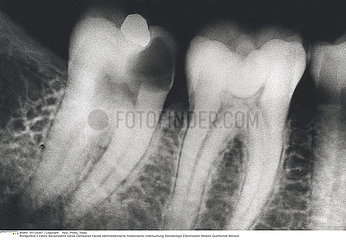 CARIE DENT RADIO!!TOOTH DECAY  X-RAY