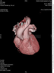 COEUR SCANNER 3D!!HEART  3D SCAN