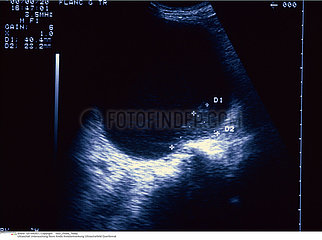 CANCER REIN ECHOGRAPHIE!CANCER OF THE KIDNEY  SONOGRAPHY