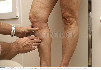 JAMBE SEMIOLOGIE 3EME AGE!!LEG  SEMIOLOGY IN ELDERLY PERSON