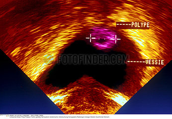 POLYPE VESSIE ECHOGRAPHIE!!POLYP IN THE BLADDER  SONOGRAPHY