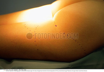 CELLULITE CHIRURGIE!!CELLULITIS  SURGERY