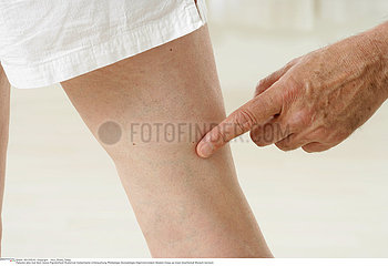 JAMBE SEMIOLOGIE 3EME AGE!!LEG  SYMPTOMATOLOGY IN ELDERLY.P