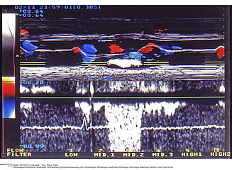 PROLAPSUS MITRAL ECHOGRAPHIE!!MITRAL PROLAPSE SONOGRAPHY
