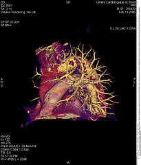 ATHEROSCLEROSE AORTE SCANNER 3D!!AORTIC ATHEROSCLEROSIS  3D SCAN