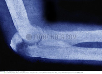 FRACTURE COUDE RADIO!!FRACTURED ELBOW  X-RAY
