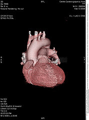 COEUR SCANNER 3D!!HEART  3D SCAN