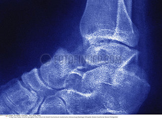 FRACTURE ASTRAGALE RADIO!!FRACTURED ANCKLE BONE  X-RAY