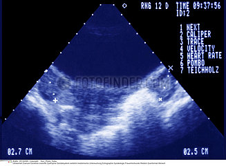 DYSTROPHIE OVAIRE!!OVARY  DYSTROPHY