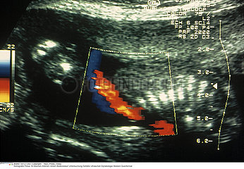 CORDON OMBILICAL ECHOGRAPHIE!!UMBILICAL CORD  SONOGRAPHY