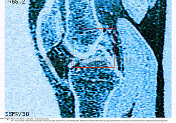 RUPTURE LIGAMENT RMN!!RUPTURED LIGAMENT  MRI