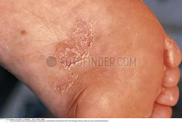 MYCOSE PIED!!MYCOSIS ON A FOOT