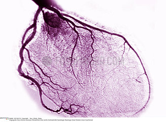 COEUR ANGIOGRAPHIE!!HEART  ANGIOGRAPHY