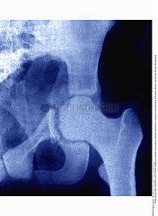 FRACTURE HANCHE RADIO!!FRACTURED HIP  X-RAY