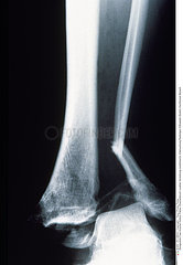 FRACTURE CHEVILLE RADIO!!FRACTURED ANKLE  X-RAY