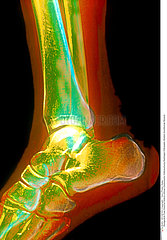 CHEVILLE RADIO!!ANKLE  X-RAY