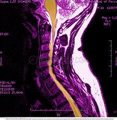 ARTHROSE CERVICALE RMN!CERVICAL ARTHROSIS  MRI