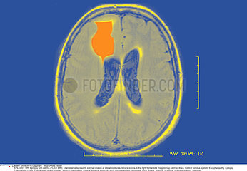 EPILEPSIE RMN!EPILEPSY  MRI