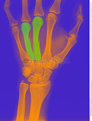 FRACTURE MAIN RADIO!FRACTURED HAND  X-RAY